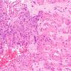 7B4 Meningoangiomatosis (Case 7) H&E 20X 2