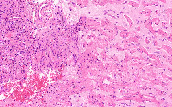 7B4 Meningoangiomatosis (Case 7) H&E 20X 2