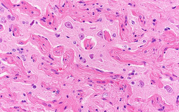 7B5 Meningoangiomatosis (Case 7) H&E 40X 2