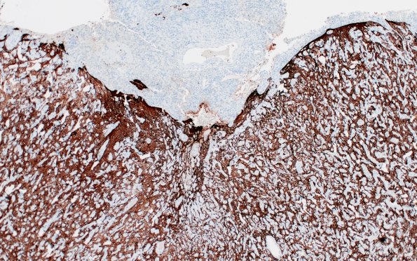 7C2 Meningoangiomatosis (Case 7) GFAP 4X