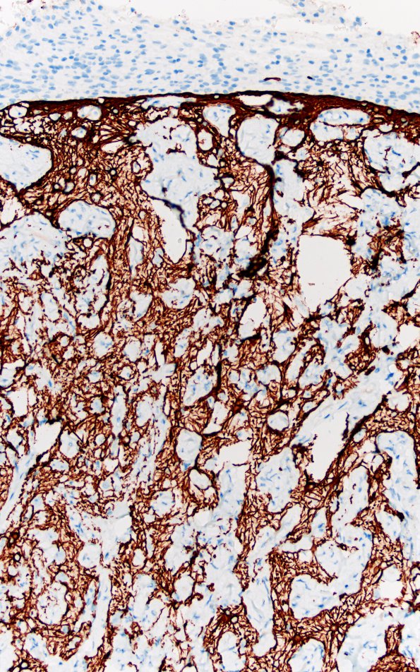 7C3 Meningoangiomatosis (Case 7) GFAP 20X