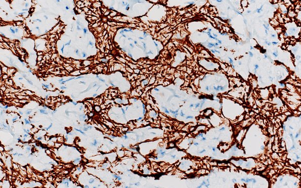 7C4 Meningoangiomatosis (Case 7) GFAP 40X