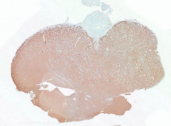 7D1 Meningoangiomatosis (Case 7) SYN WM (2)