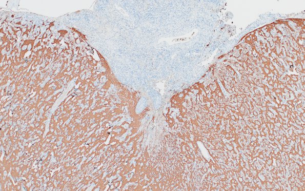 7D2 Meningoangiomatosis (Case 7) SYN 4X