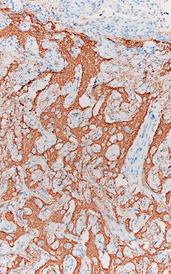 7D3 Meningoangiomatosis (Case 7) SYN 20X