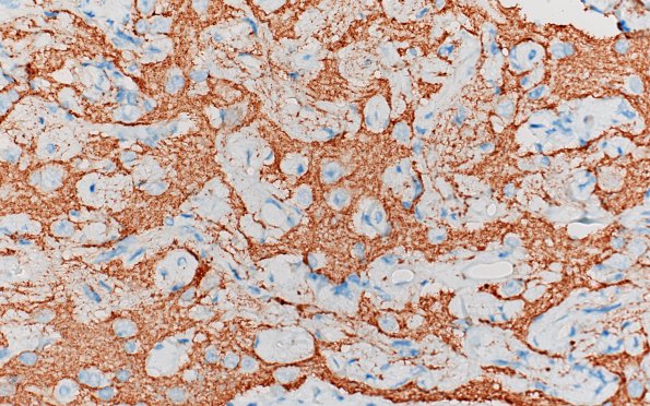 7D4 Meningoangiomatosis (Case 7) SYN 40X