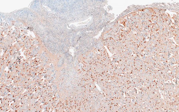 7E2 Meningoangiomatosis (Case 7) NeuN 4X