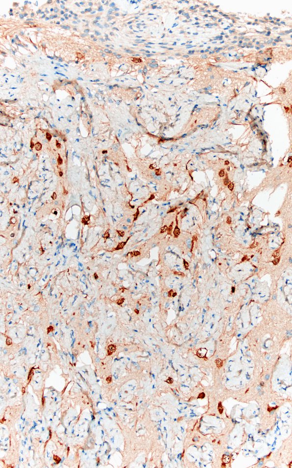 7E3 Meningoangiomatosis (Case 7) NeuN 20X