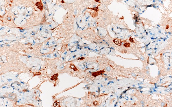 7E4 Meningoangiomatosis (Case 7) NeuN 40X