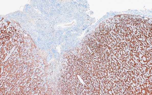 7F2 Meningoangiomatosis (Case 7) NF 4X