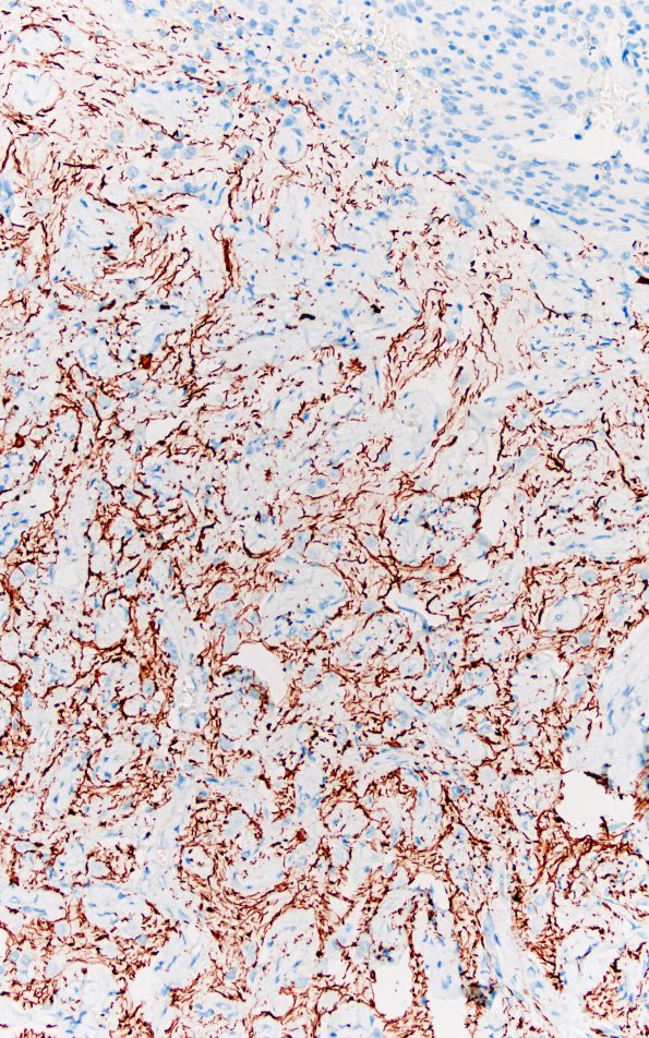 7F3 Meningioangiomatosis (Case 7) NF 20X