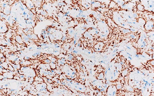 7F4 Meningoangiomatosis (Case 7) NF 40X