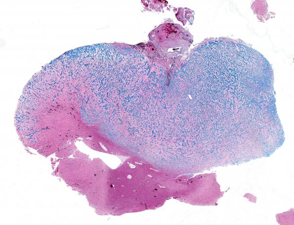 7G1 Meningoangiomatosis (Case 7) TRI WM 2