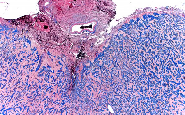 7G2 Meningoangiomatosis (Case 7) TRI 4X