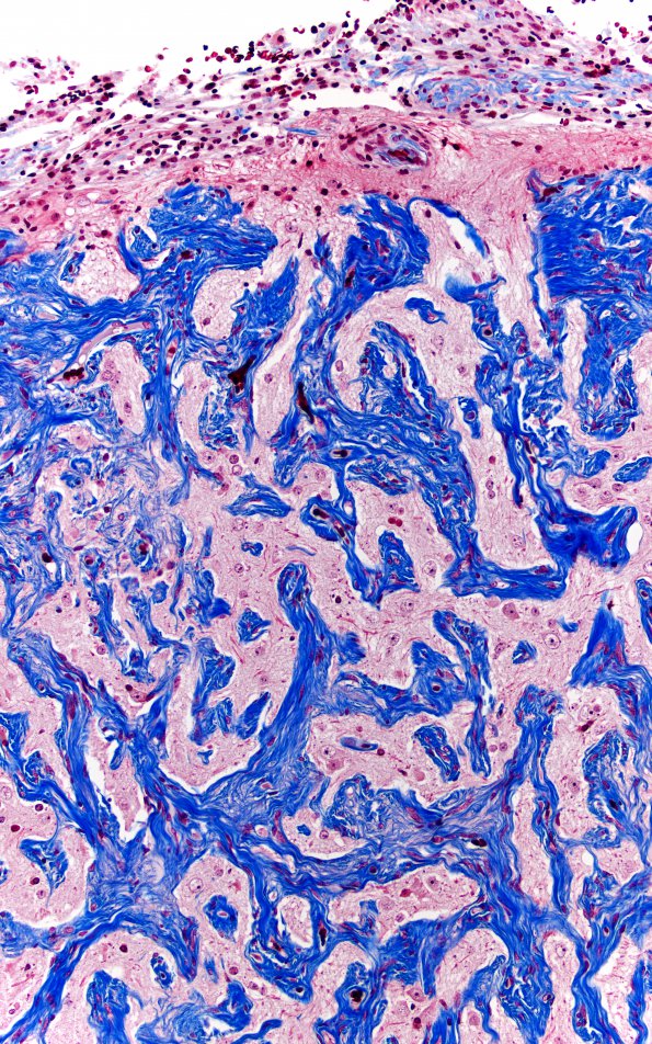 7G3 Meningoangiomatosis (Case 7) TRI 20X