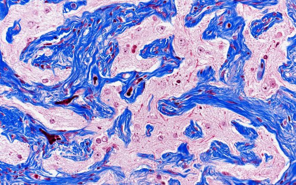 7G4 Meningoangiomatosis (Case 7) TRI 40X