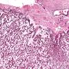 7H2 Meningoangiomatosis (Case 7) Retic 4X