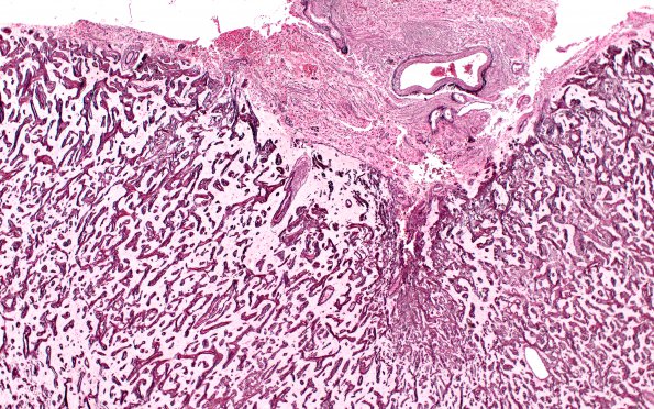7H2 Meningoangiomatosis (Case 7) Retic 4X