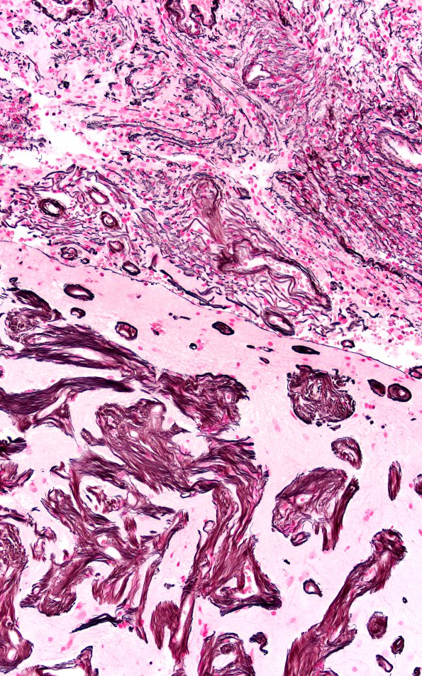 7H3 Meningoangiomatosis (Case 7) Retic 20X