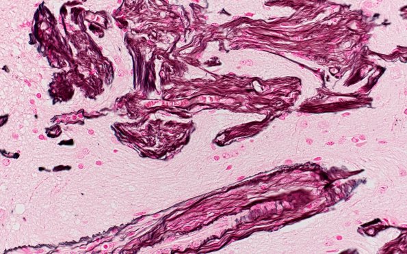 7H4 Meningoangiomatosis (Case 7) Retic 40X