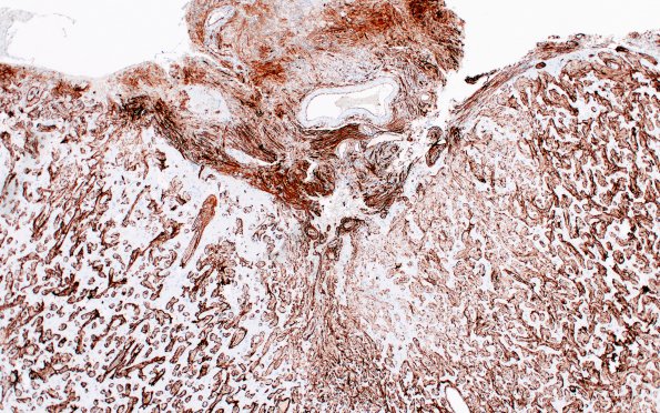 7I2 Meningoangiomatosis (Case 7) CD34 4X