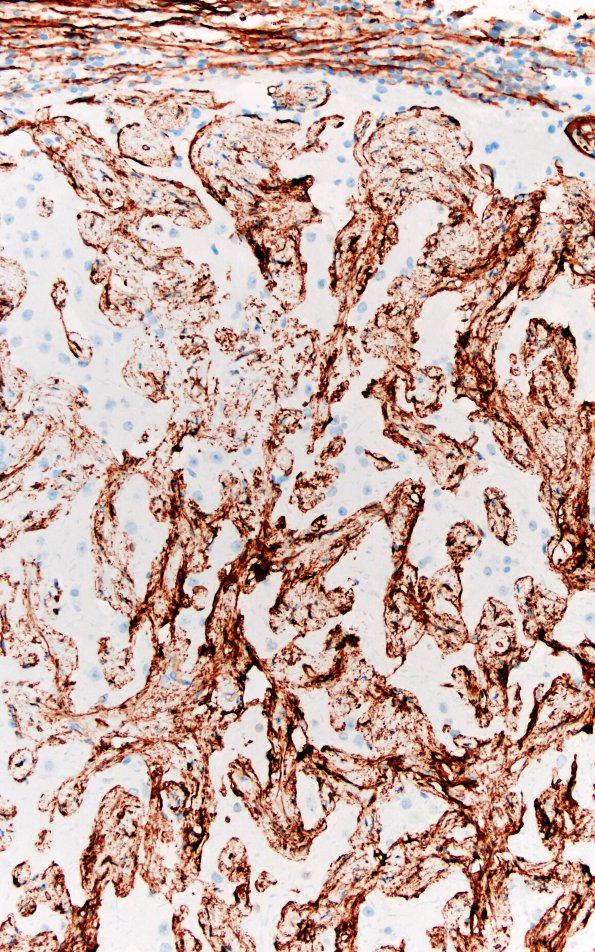 7I3 Meningoangiomatosis (Case 7) CD34 20X