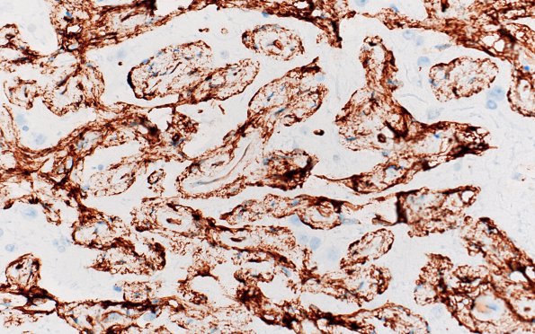 7I4 Meningoangiomatosis (Case 7) CD34 40X