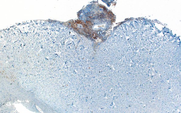 7J1 Meningoangiomatosis (Case 7) EMA 2X