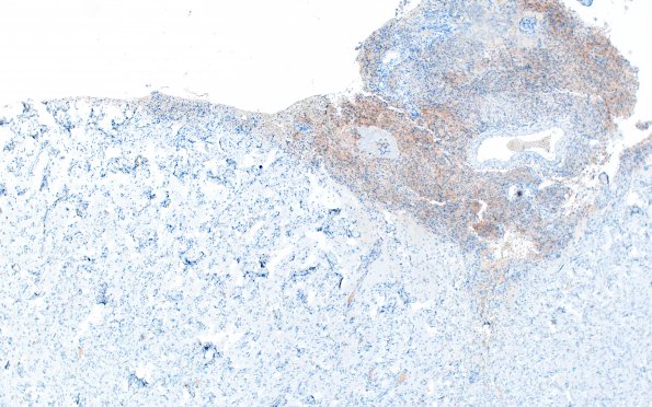 7J2 Meningoangiomatosis (Case 7) EMA 4X