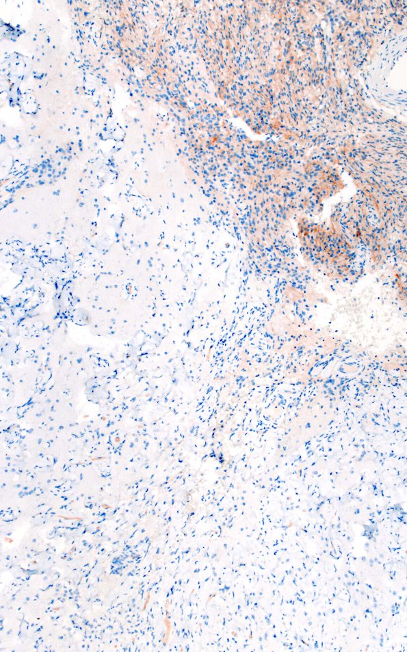 7J3 Meningoangiomatosis (Case 7) EMA 10X