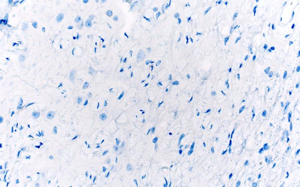 7J4 Meningoangiomatosis (Case 7) EMA 40X