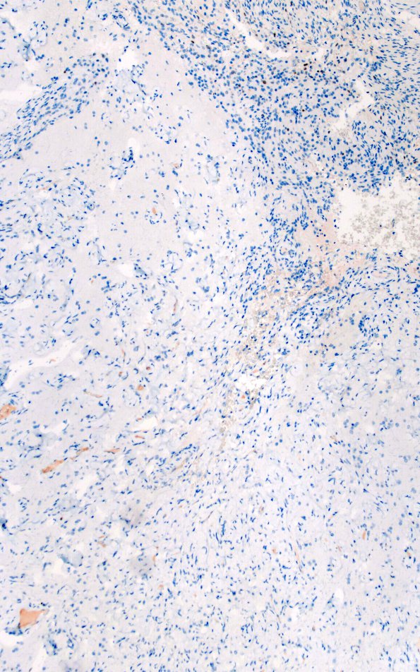 7K1 Meningoangiomatosis (Case 7) PR 10X