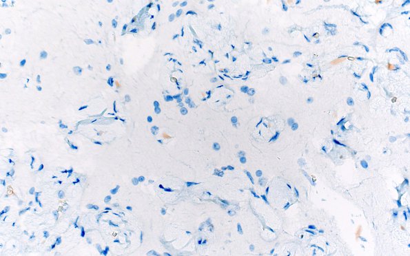 7K2 Meningoangiomatosis (Case 7) PR 40X