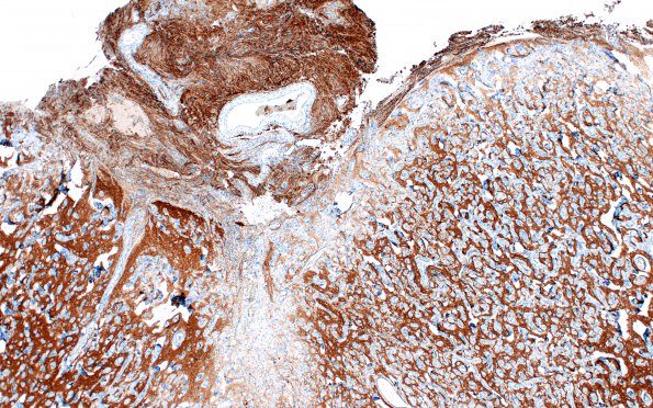 7L2 Meningoangiomatosis (Case 7) SSt2A 4X
