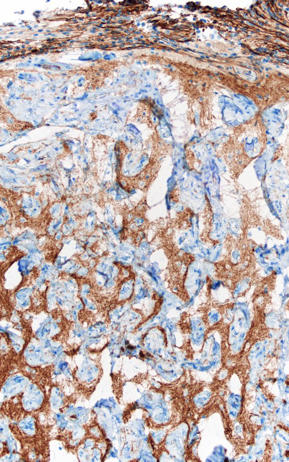 7L3 Meningoangiomatosis (Case 7) SSt2A 10X