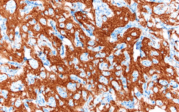 7L5 Meningoangiomatosis (Case 7) SSt2A 20X 4