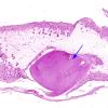 4 Meningocoele ectopic brain (Case 4)