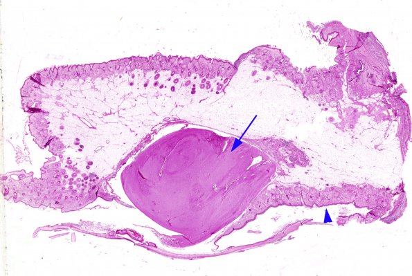 4 Meningocoele ectopic brain (Case 4)