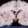 1A1 Microencephaly (Case 1) Gross 2