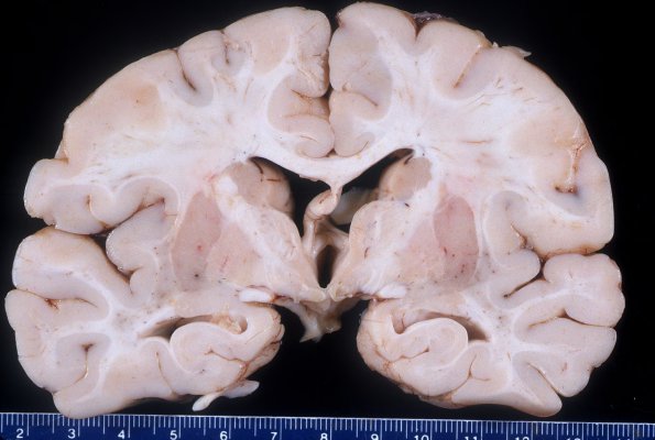 1A1 Microencephaly (Case 1) Gross 2