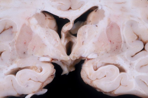 1A2 Microencephaly (Case 1) Gross 3