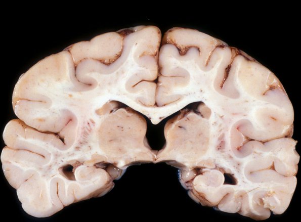 1A3 Microencephaly (Case 1) Gross 1