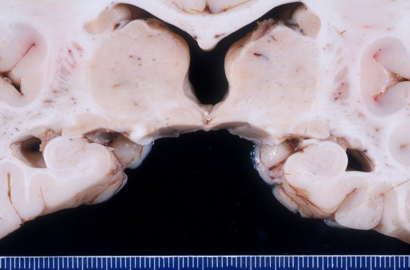 1A4 Microencephaly (Case 1) Gross 4