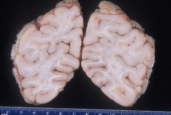 1A5 Microencephaly (Case 1) Gross 5