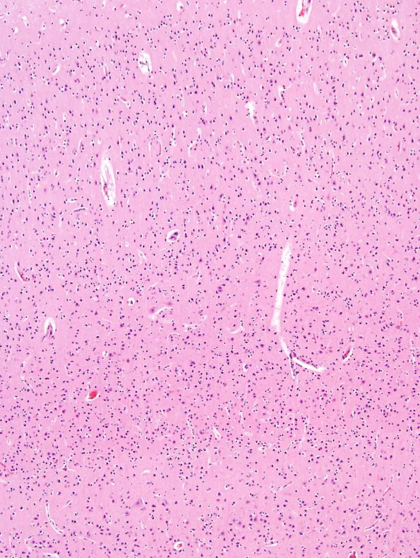 1B2 Microencephaly (Case 1) N5 H&E 10X Cell Sens