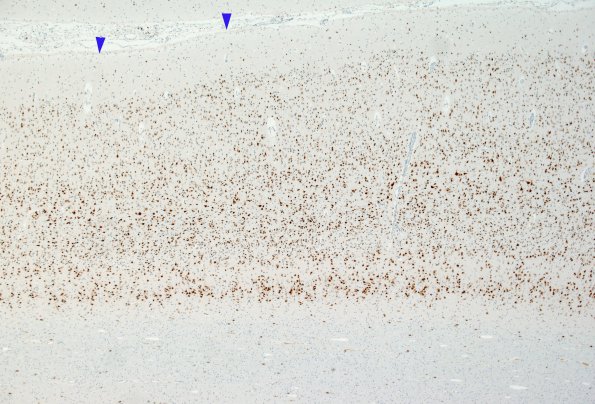 1C2 Microencephaly (Case 1) N5 NeuN 4X