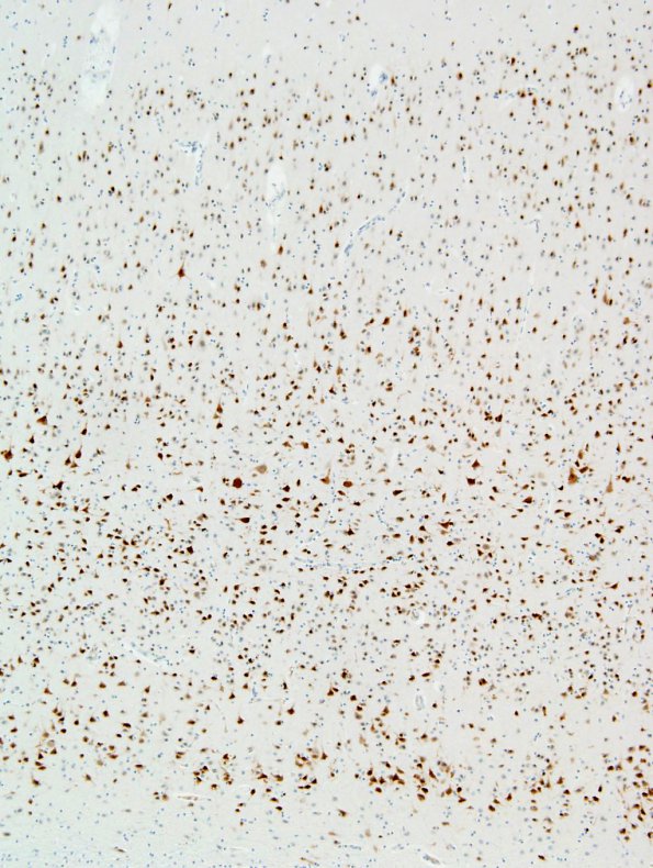 1C3 Microencephaly (Case 1) N5 NeuN 10X CellSens