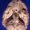 2A1 Microencephaly vera, 770 gm (Case 2) 3