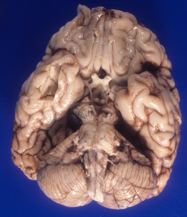 2A1 Microencephaly vera, 770 gm (Case 2) 3