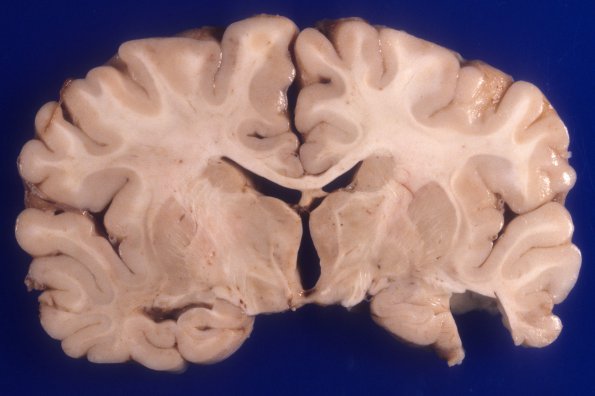 2A3 Microencephaly vera, microcephaly vera, 770 gm (Case 2) 2